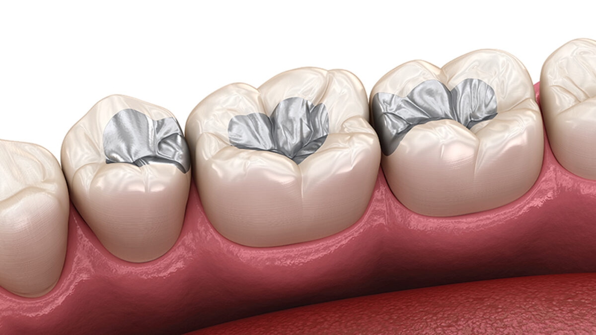 Amalgam Dolgular Zararlı mı?